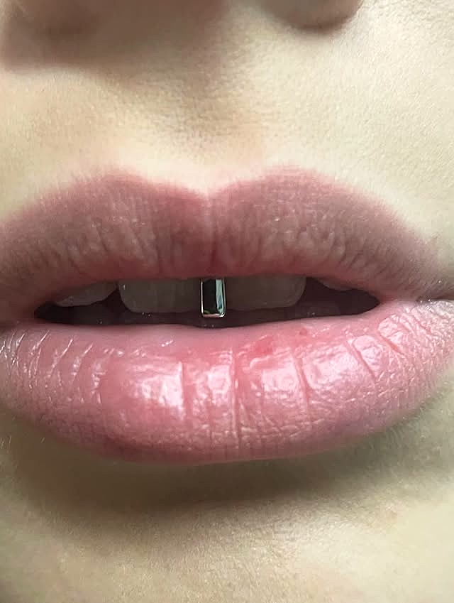 Minimal single-tooth silver bar cap fitted on a client